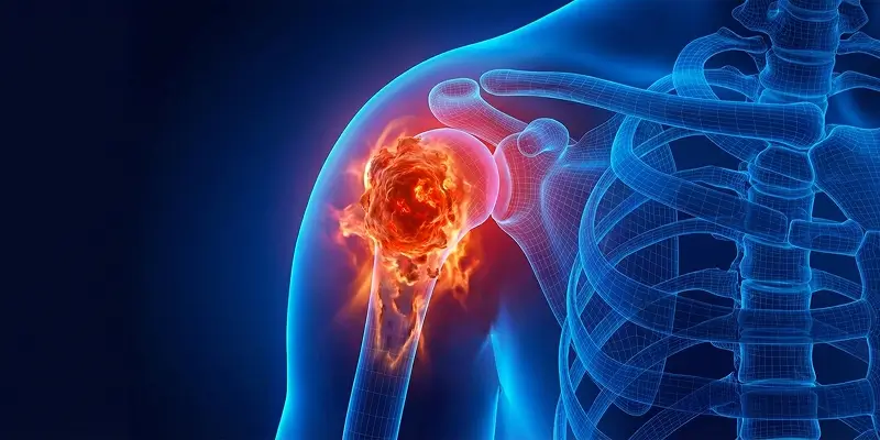 Anevrizmal Kemik Kisti (AKK) Tedavisi ve Cerrahi Yöntemler