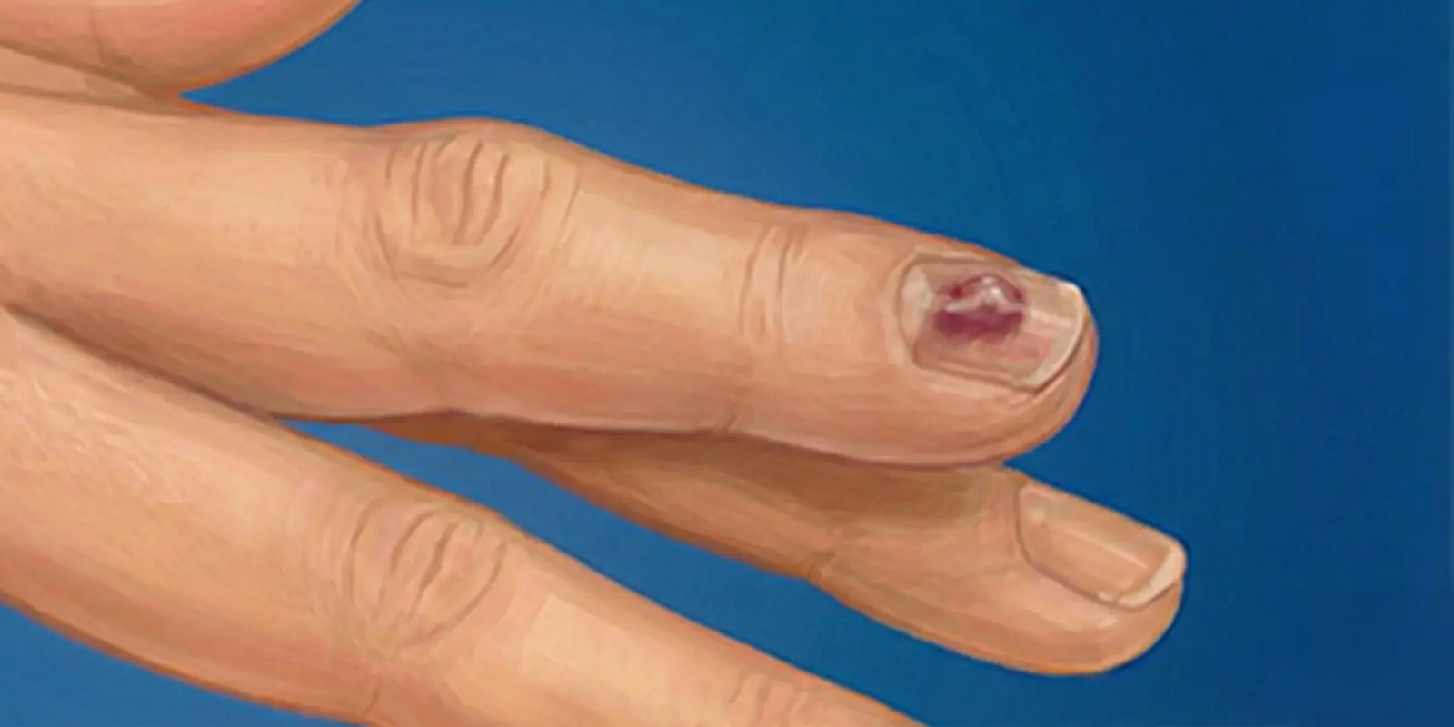 Glomus Tümörü (Tırnak Yatağı Tümörü) Nedir? Belirtileri ve Tedavisi