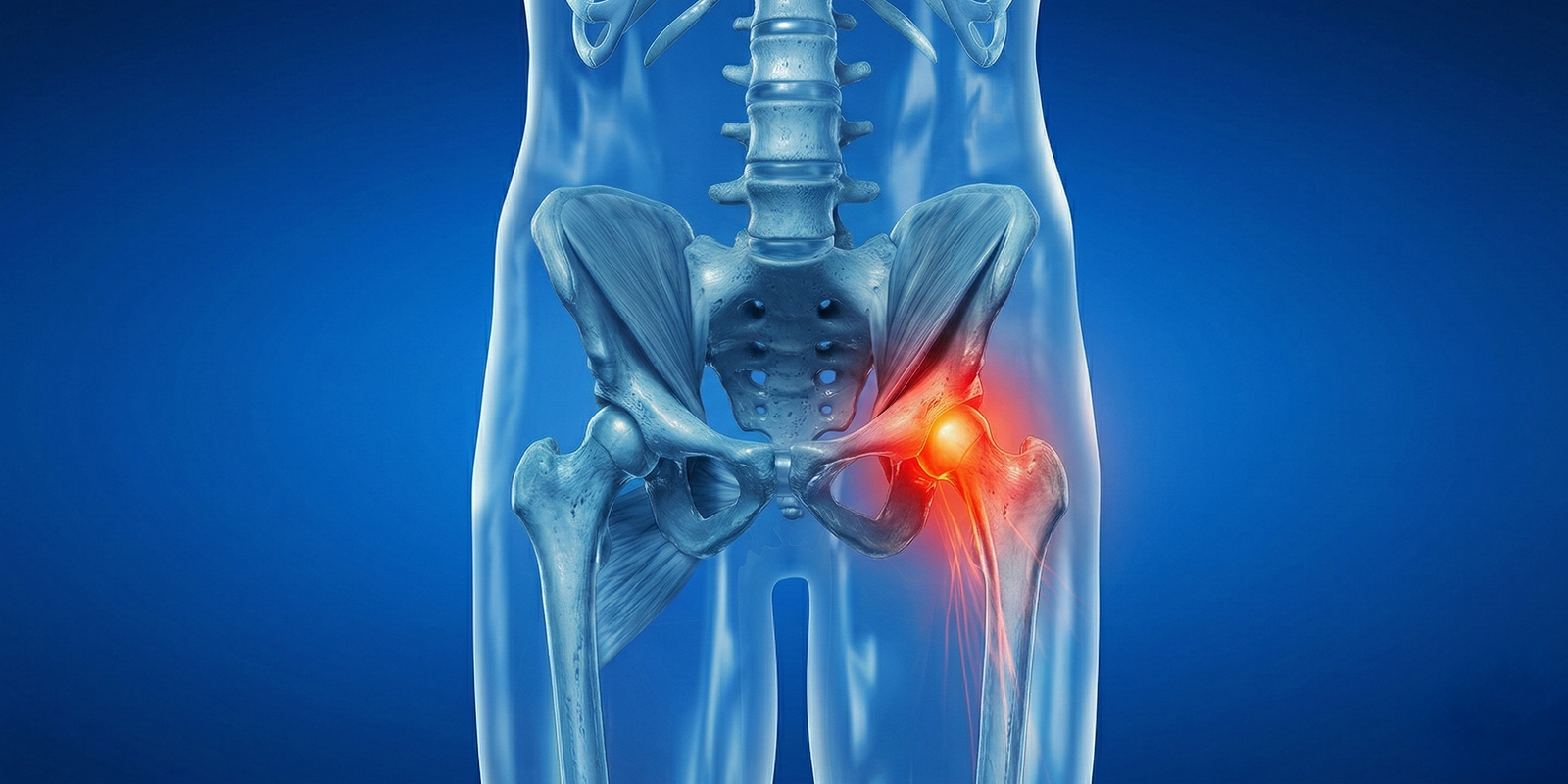 Kalça Çıkığı Neden Olur? Belirtileri Nelerdir, Tedavi Süreci