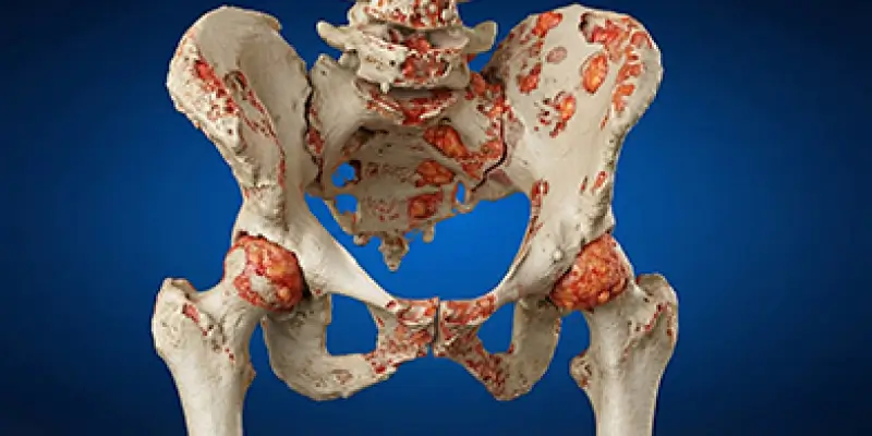 Kemik Metastazı Nedir? Tanı Ve Tedavileri Nelerdir?