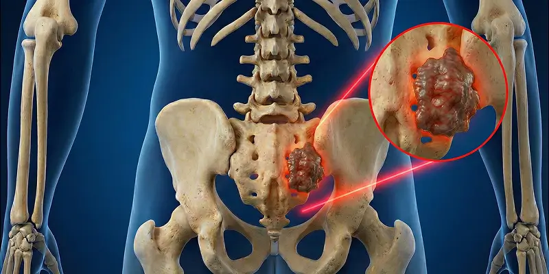 Kordoma Nedir? Omurga ve Kuyruk Sokumu Tümörü Tedavisi
