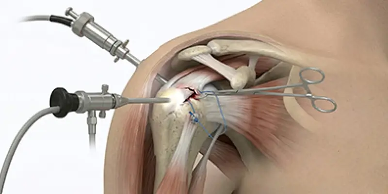 Omuz Artroskopisi (Bankart, Rotator Manşet)