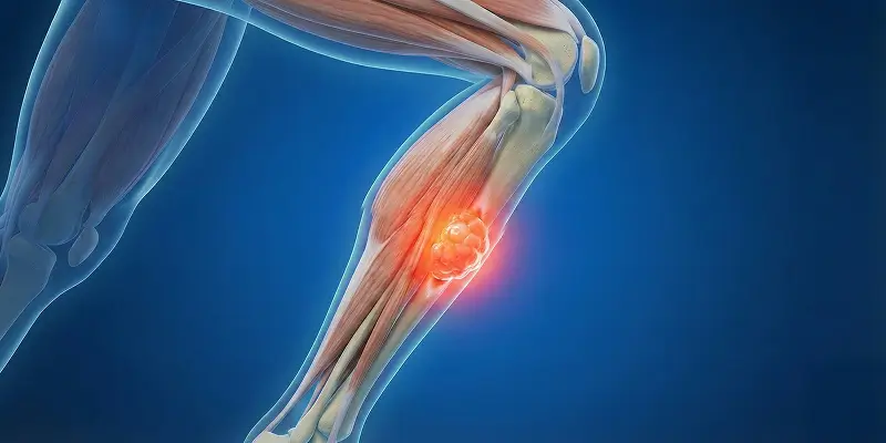 Osteoid Osteoma: Gece Ağrısı Yapan Kemik Tümörü ve Tedavisi