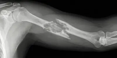 Patolojik Kırık Nedenleri, Tedavisi ve Önlenmesi