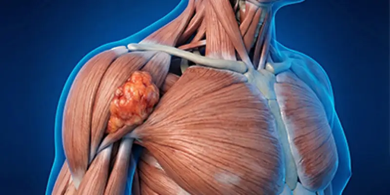 Yumuşak Doku Sarkomu